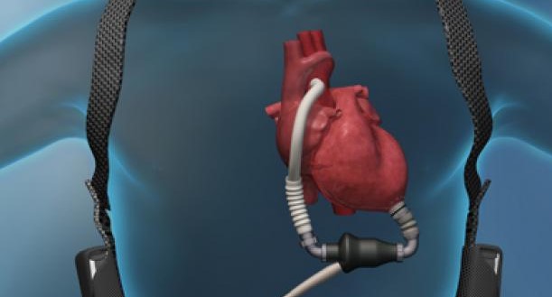 corazonartificial